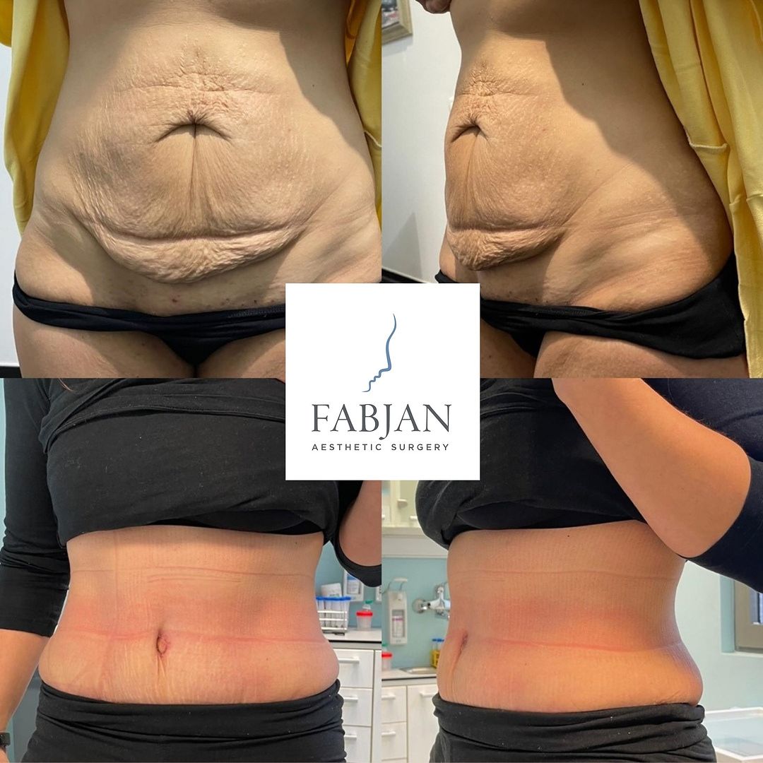 Abdominoplastik Transformation Fabjan Aesthetics