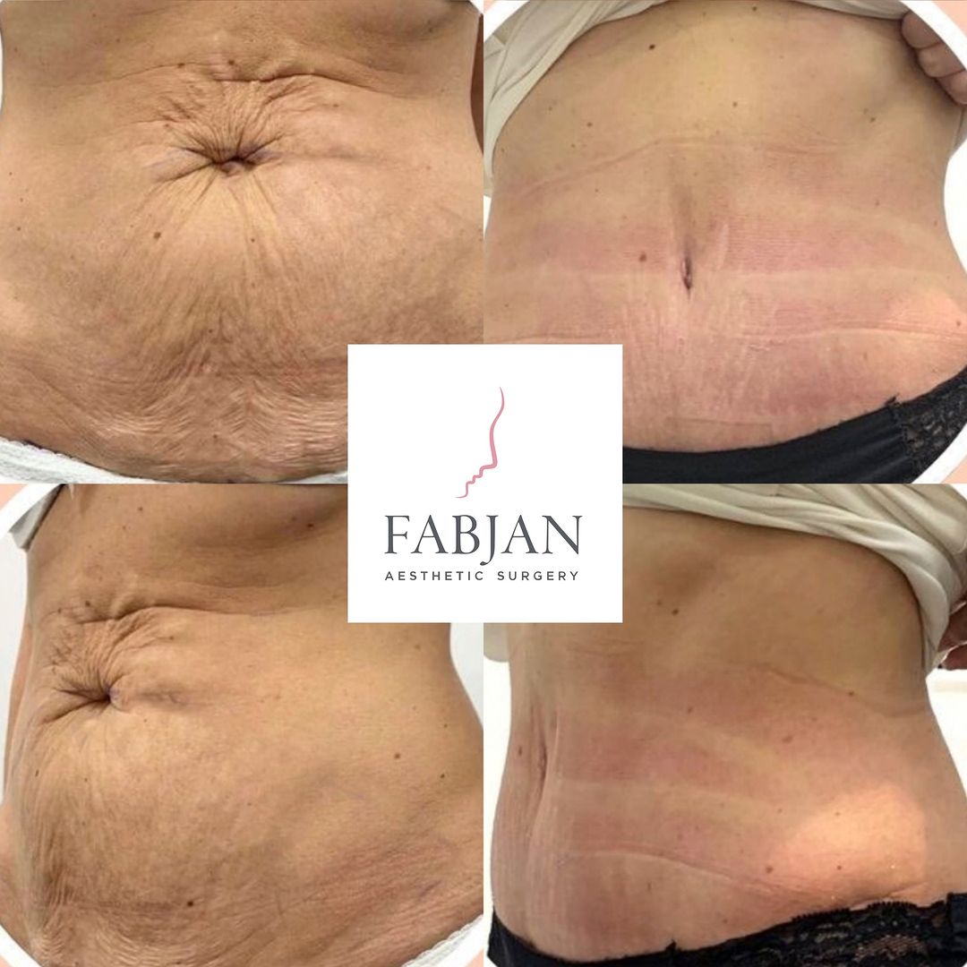 Abdominoplastik Transformation Fabjan Aesthetics