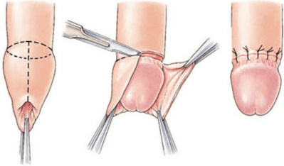 Circumcision Procedure at Fabjan Aesthetics