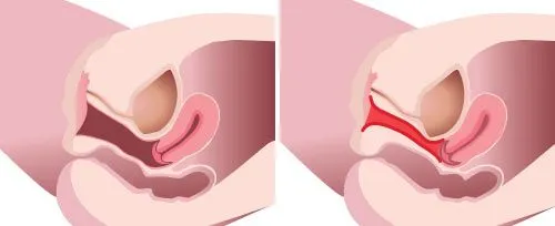 Lasersko zdravljenje ohlapne nožnice prej/potem; Courtesy of: Fotona