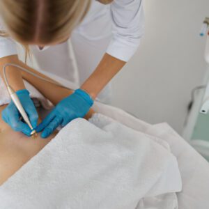 Closeup electro epilation cosmetology procedure for hair removal from woman abdomen. Medical care